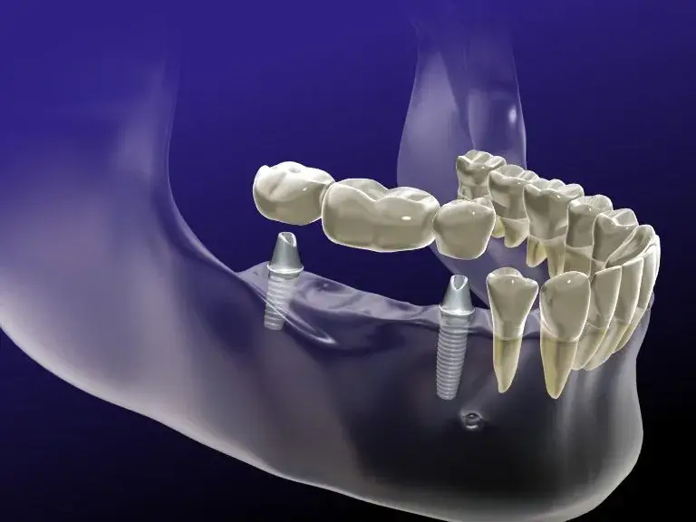 Dental implant using titanium screws into jaw