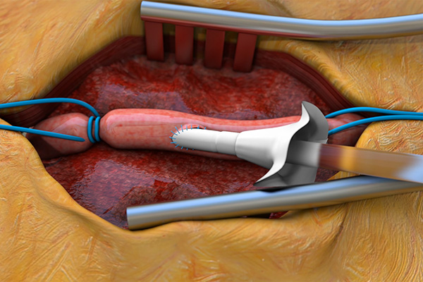 All Vascular medical device